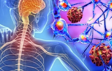 Expert Explains MS: Treatment is Personalized